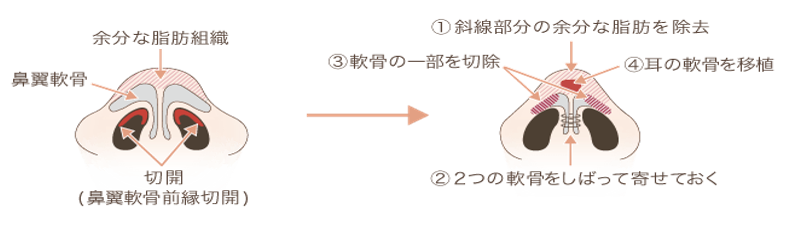 鼻尖縮小 耳介軟骨移植 美容整形 美容外科なら水の森美容外科 公式 総合サイト 鼻尖縮小 耳介軟骨移植 美容整形 美容外科なら水の森美容外科 公式 総合サイト