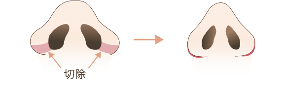 小鼻縮小の手術方法