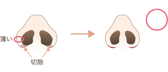 小鼻縮小の効果が出やすいタイプの鼻