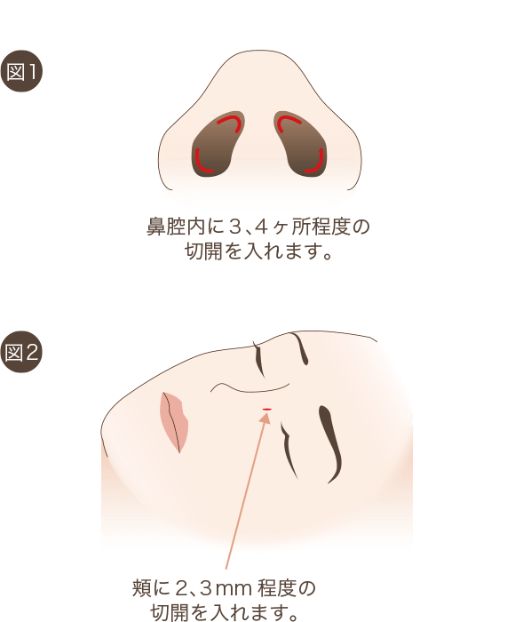 鼻骨骨切りの手術方法1