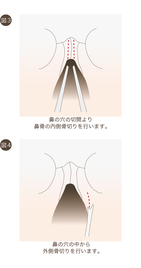 鼻骨骨切りの手術方法2