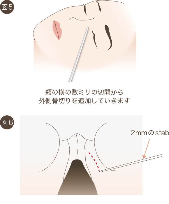 鼻骨骨切りの手術方法3