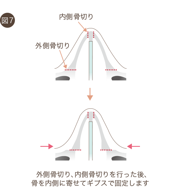 鼻骨骨切りの手術方法4