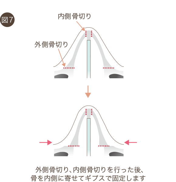 鼻骨骨切りの整形について 美容整形 美容外科なら水の森美容外科 公式 総合サイト