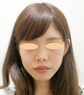 鼻のヒアルロン酸注入の症例（術前）