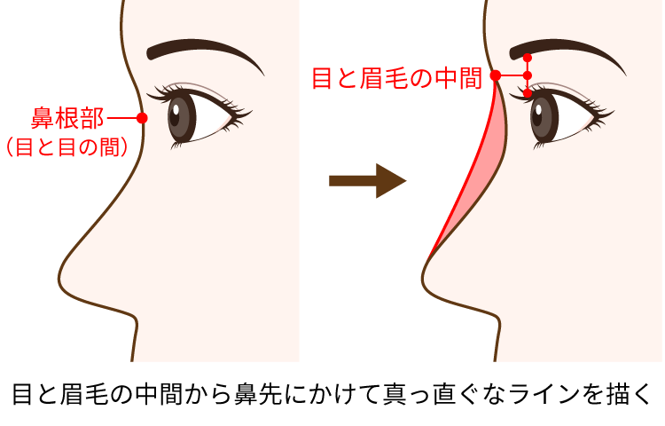鼻のヒアルロン酸注入についての解説図1