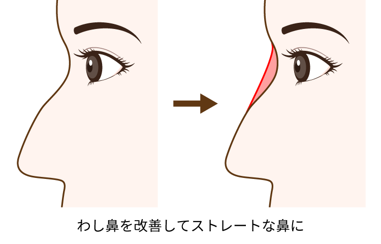 鼻のヒアルロン酸注入についての解説図3