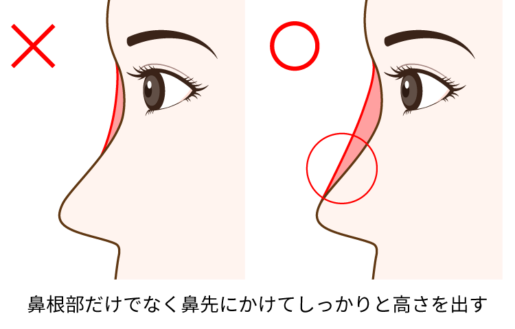 鼻のヒアルロン酸注入の注意点