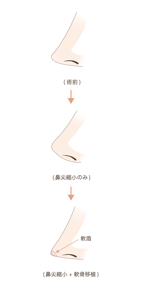 耳介軟骨移植とは?説明図