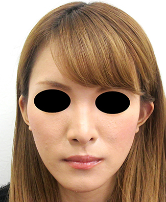 鼻骨骨切り、鼻中隔延長の症例写真（術後）