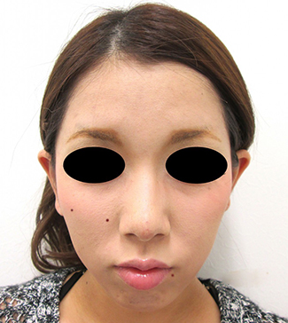 鼻骨骨切り、鼻尖縮小の症例写真（術後）