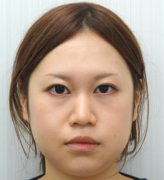小鼻縮小の症例写真（術後）
