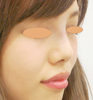 隆鼻術　鼻ヒアルロン酸の症例写真（術後）