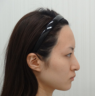 わし鼻修正（ハンプ修正）の症例写真（術後）