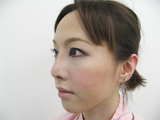隆鼻術で高くして鼻筋を通すイメージの症例（術後）