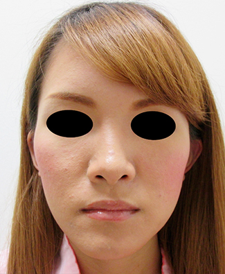 鼻骨骨切り、鼻中隔延長の症例写真（術前）