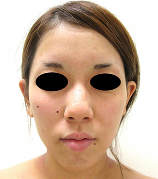 鼻骨骨切り、鼻尖縮小の症例写真（術前）