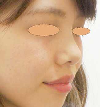 隆鼻術　鼻ヒアルロン酸の症例写真（術前）