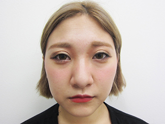 鼻骨骨切りの症例写真（術前）