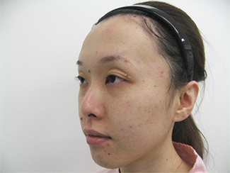 隆鼻術で高くして鼻筋を通すイメージの症例（術前）