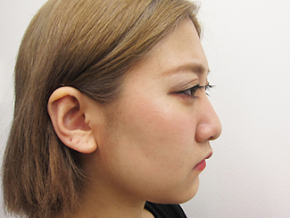 鼻骨骨切りで鼻を細くして鼻筋を通すパターンの症例（術前）横向き