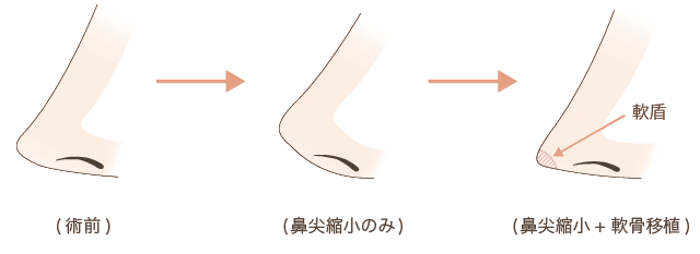 耳介軟骨移植の解説図