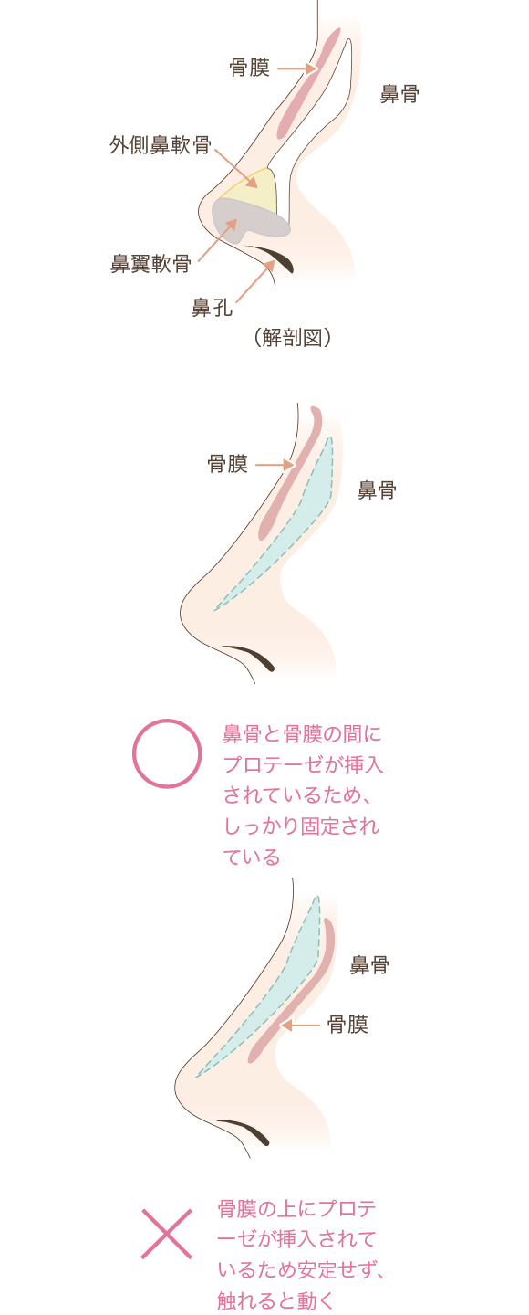 鼻プロテーゼを挿入する正しい層の解説図