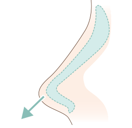 L型プロテーゼ