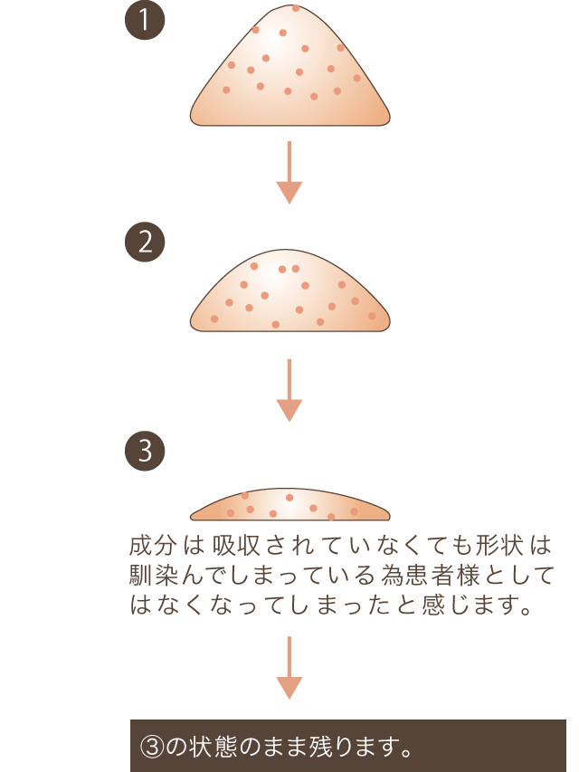 非吸収剤のヒアルロン酸は経過年数とともに成分が吸収されなくても、形状が変わっていく様子の画像