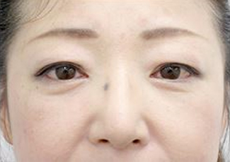 （ハムラ法）施術後