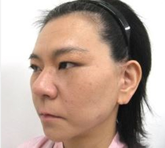 （SMAS法）施術後