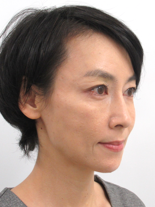 （若返り輪郭形成）施術後