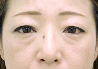 （ハムラ法）施術前