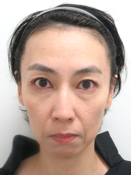 （若返り輪郭形成）施術前