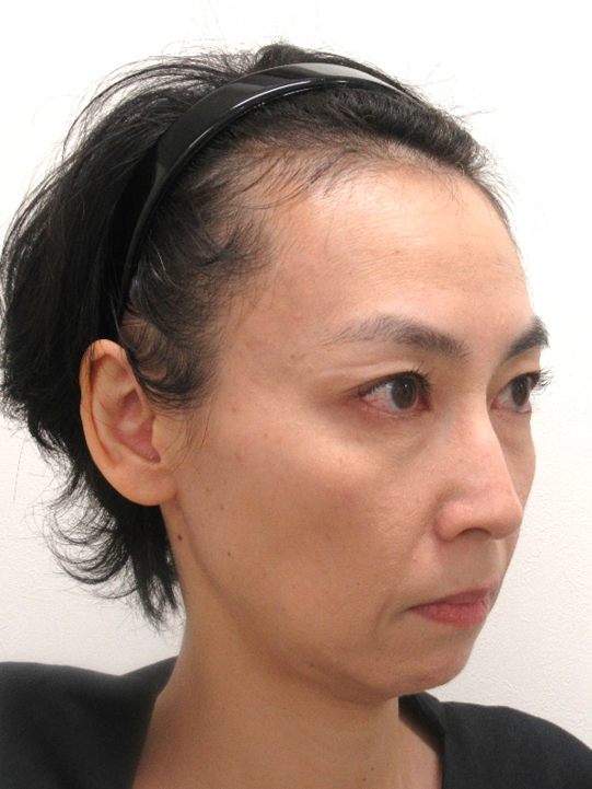 （若返り輪郭形成）施術前