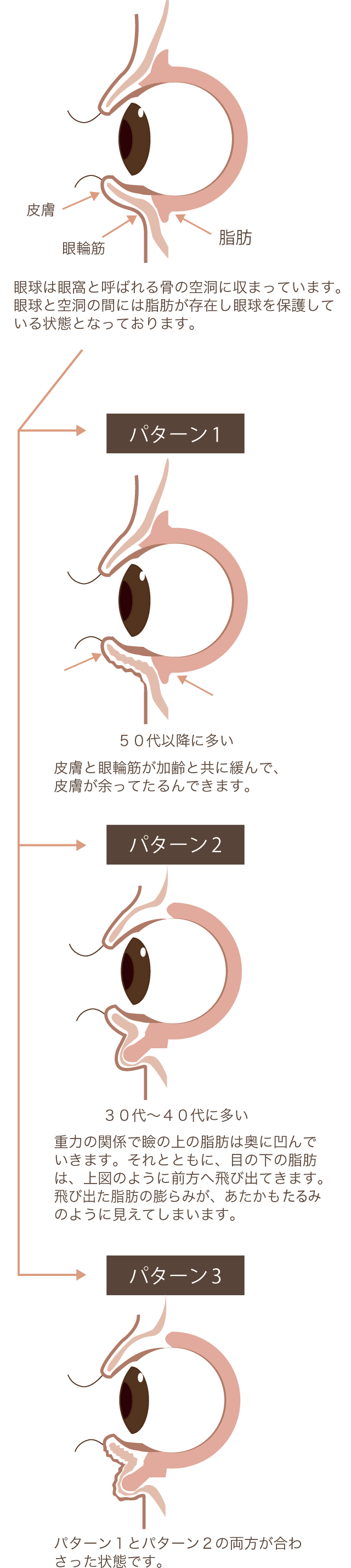 目の下のたるみ取り ハムラ法 美容整形なら水の森美容外科 公式 総合サイト 目の下のたるみ取り ハムラ法 美容整形なら水の森美容外科 公式 総合サイト