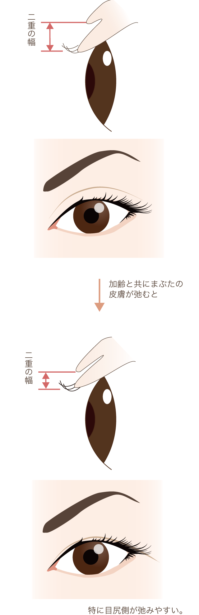 たるみの構造