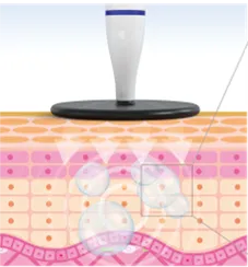 ラジオ派のプラス極性とマイナス極性が通電しあう事で熱を発する。