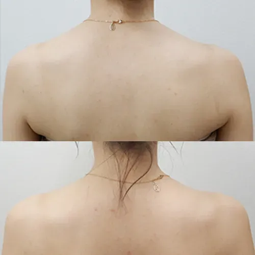 肩ボトックス注射の症例写真
