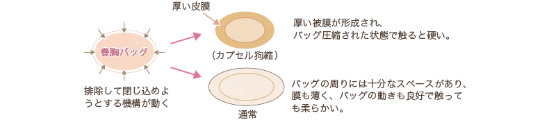 カプセル拘縮（被膜拘縮）
