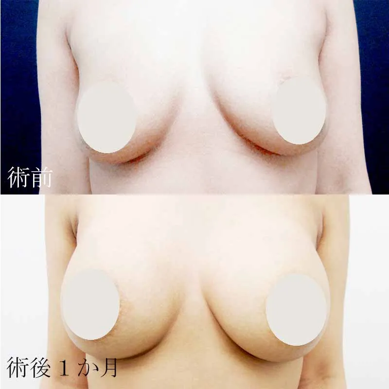 シリコンバック豊胸の症例写真
