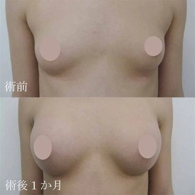 シリコンバック豊胸の症例写真