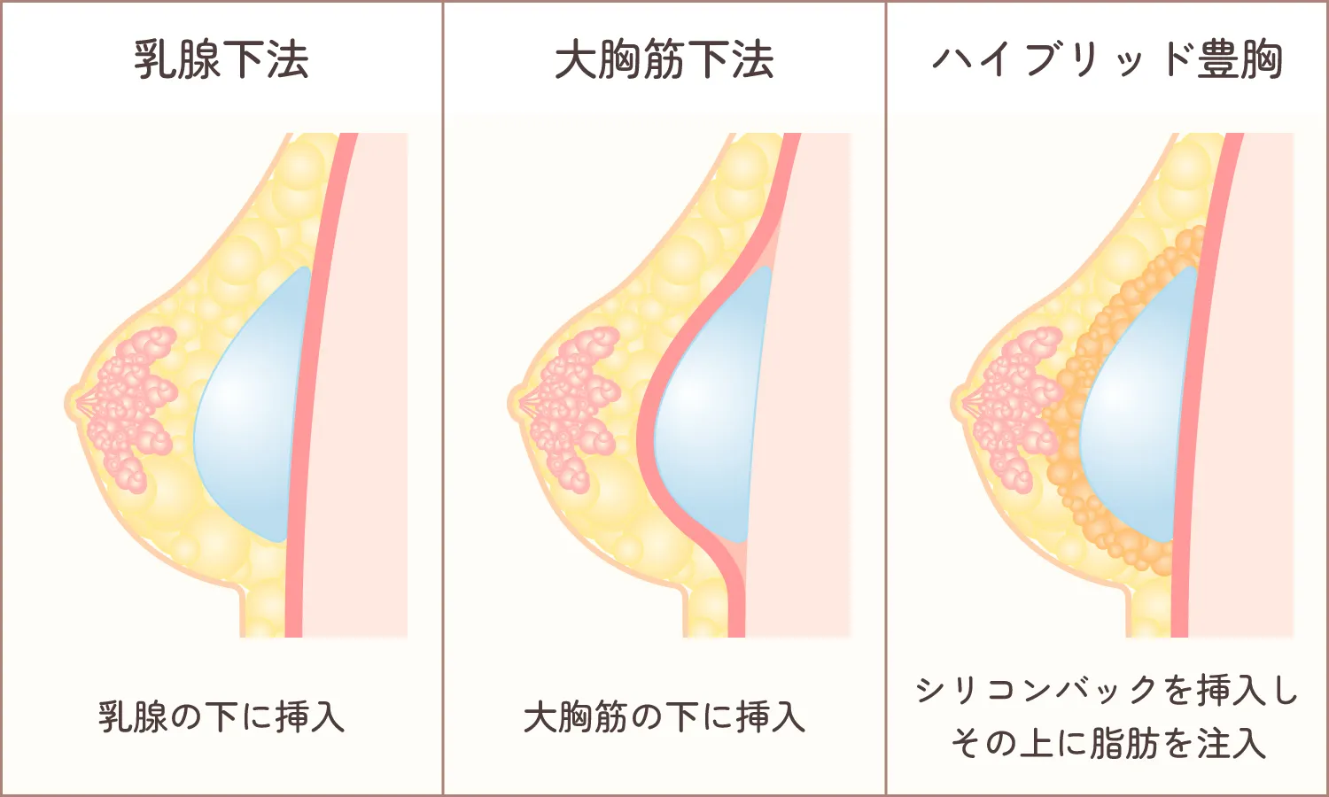 豊胸画像