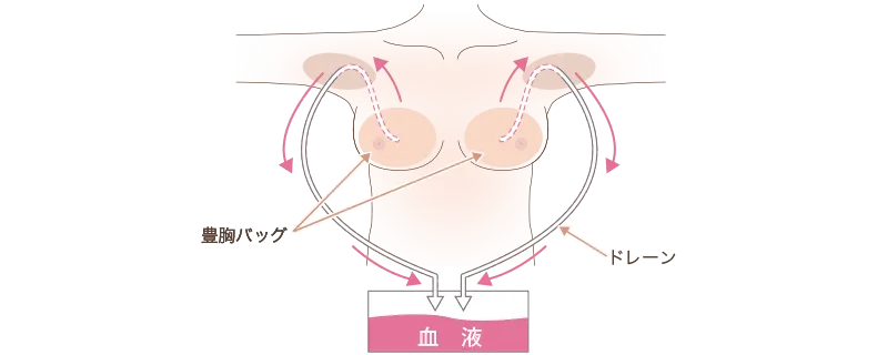 ドレーン挿入