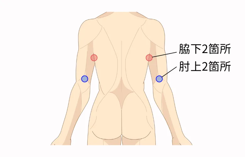 二の腕・背中の脂肪吸引の傷口の位置