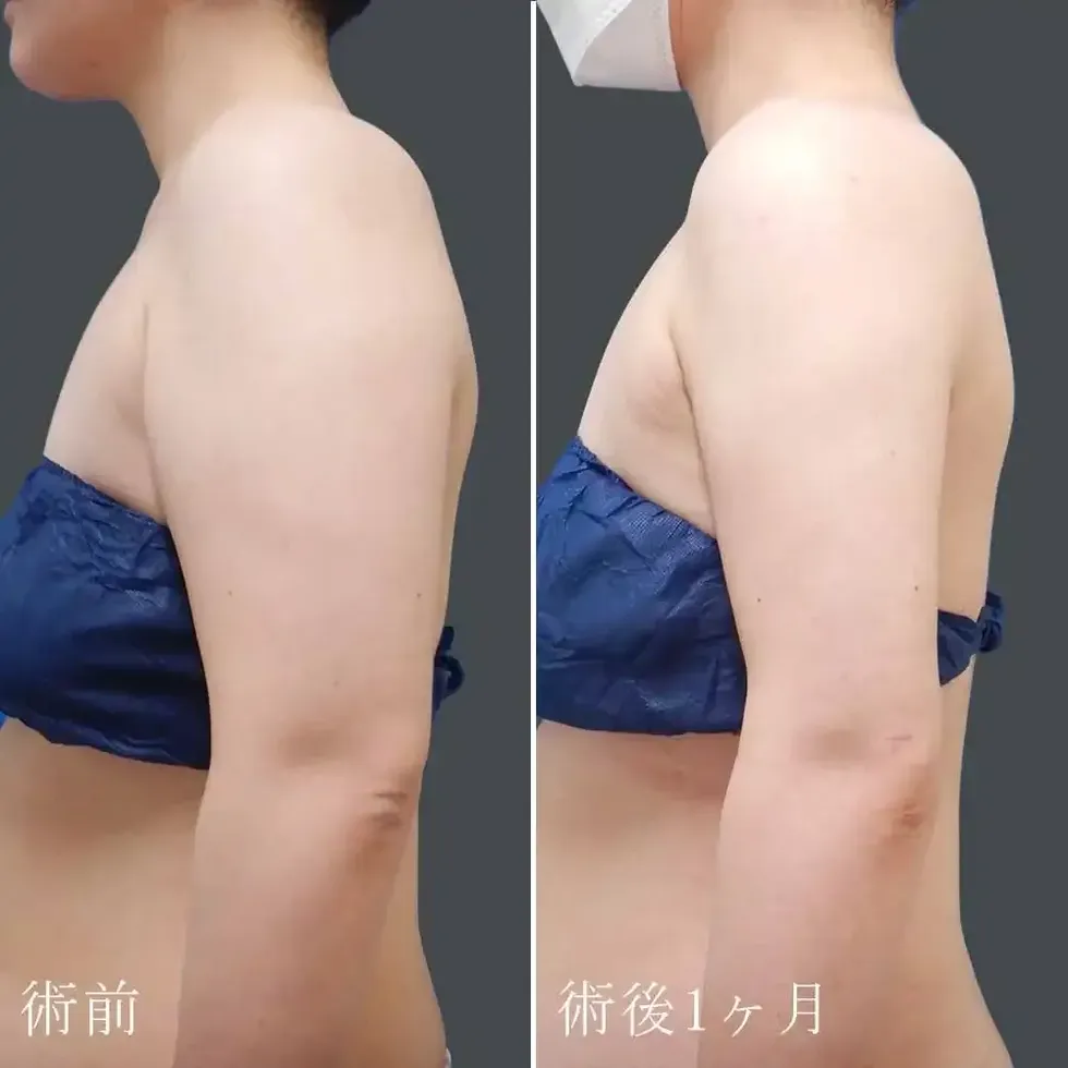 二の腕の脂肪吸引後の見た目の変化①