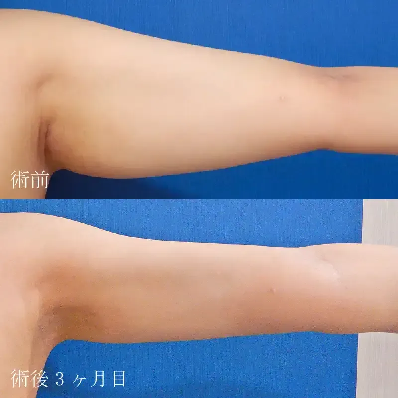 二の腕の脂肪吸引後の見た目の変化②