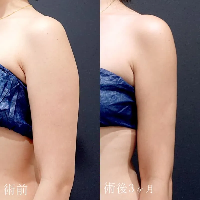 二の腕の脂肪吸引の症例写真