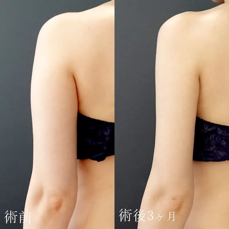 二の腕の脂肪吸引の症例写真