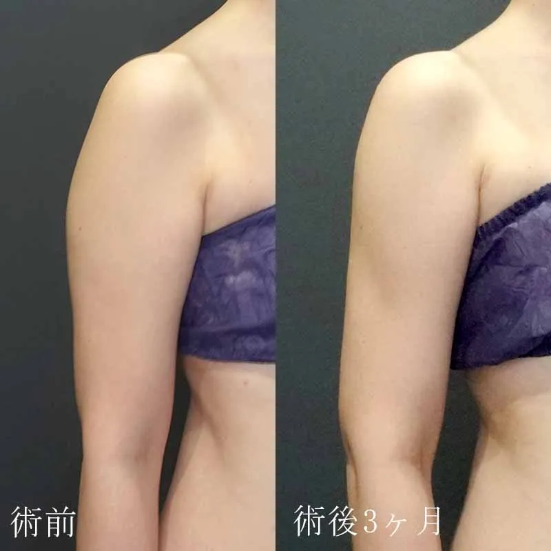 二の腕の脂肪吸引の症例写真①